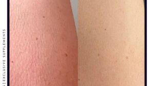 Wat te doen bij een droge huid?