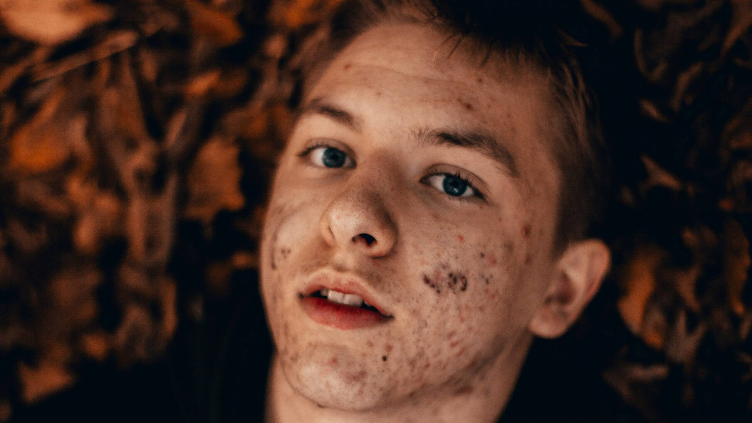 Krijg je van melk acne?