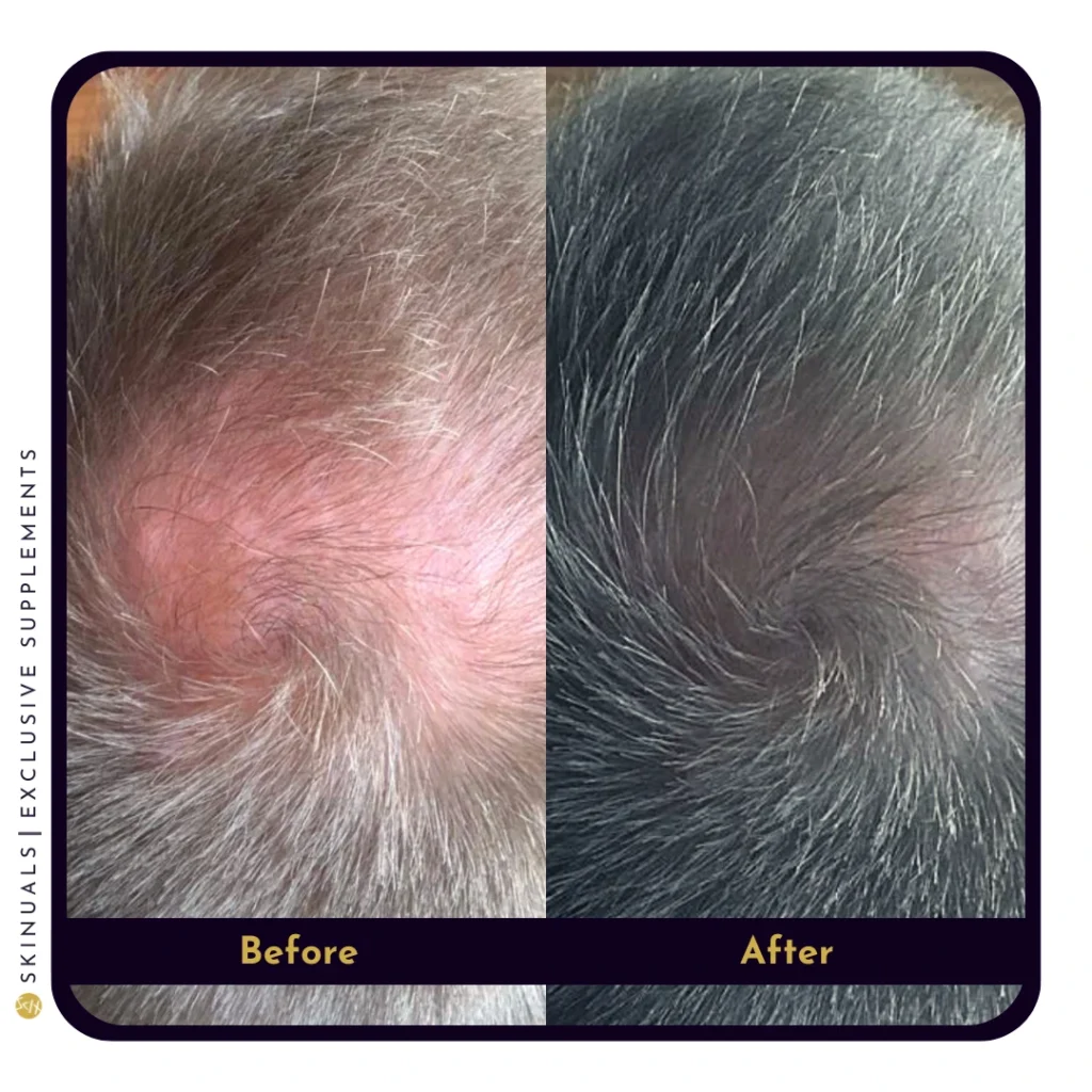 Wil je haaruitval en kaalheid tegengaan?